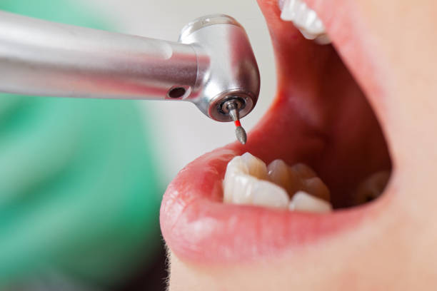 Best Urgent Dental Care for Toothache in Eulyptus Hills, CA